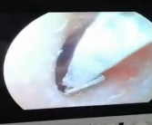 女生睡觉不摘耳钉：直径4mm钻掉耳道 卡了半个月！