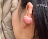 女子打耳洞长出鹌鹑蛋大肉疙瘩 医生提醒：瘢痕体质最好别打！
