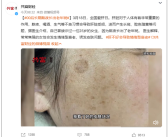长期熬夜一00后长出老年斑：还能提高数倍中风风险！