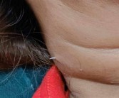 泰国女子吃鱼时被鱼刺扎穿脖子：医生直呼活久见！