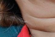 泰国女子吃鱼时被鱼刺扎穿脖子：医生直呼活久见！