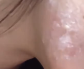 女子回应唱K感染病毒8年反复发作：嘴巴离话筒太近所致!