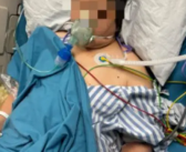 夫妻宰杀活鸭被抓伤 感染鹦鹉热衣原体住进ICU！